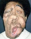 Тумор вследствие на ядрена радиация